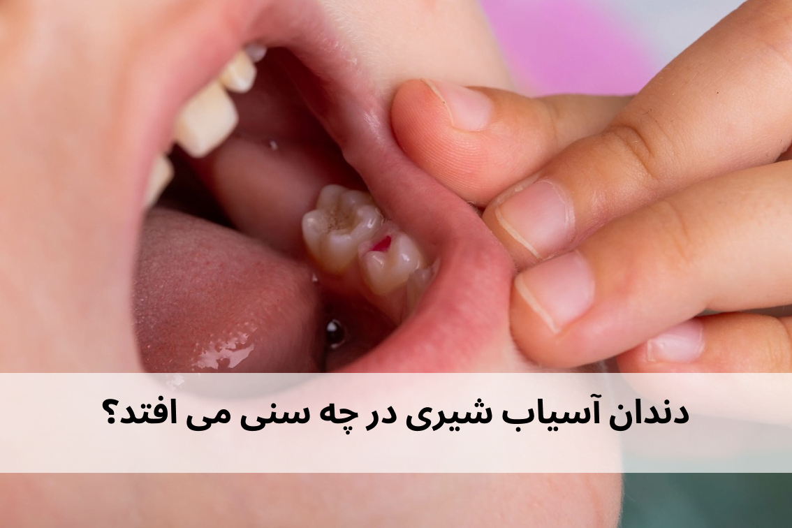 سن افتادن دندان آسیاب شیری