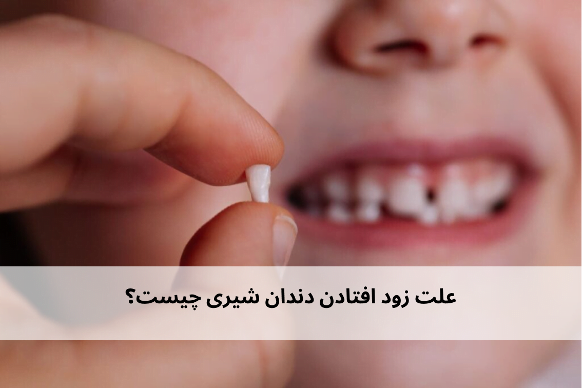 علت زود افتادن دندان شیری چیست؟