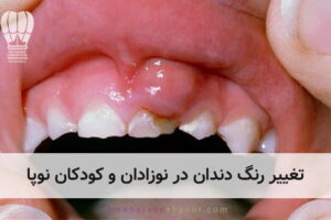 دلایل آبسه و عفونت لثه در کودکان و آشنایی با راههای درمان آن