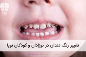 دلایل خراب شدن دندان شیری کودکان